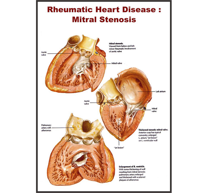 Human Diseases 3D Charts